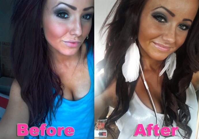 melanotan 2 före efter